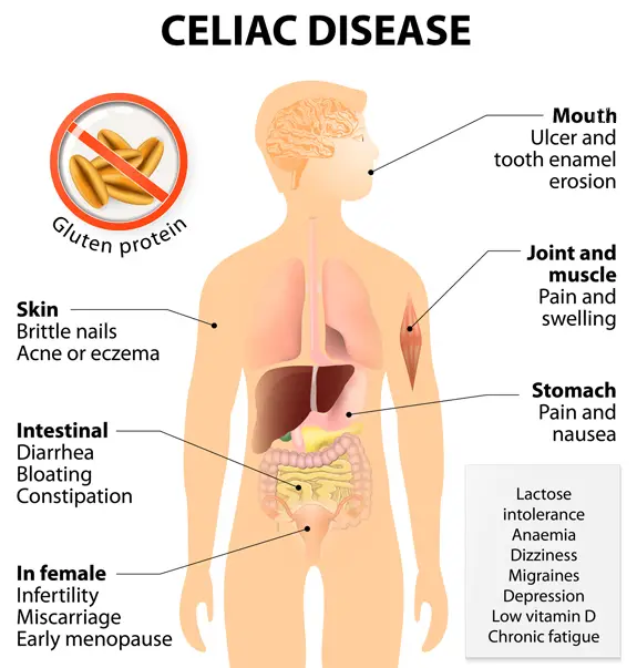 Gluten Intolerance Symptoms: Is It Celiac Disease Thats Making You Ill ...