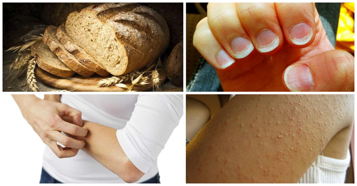 These signs and symptoms shows that you Have a Gluten ...
